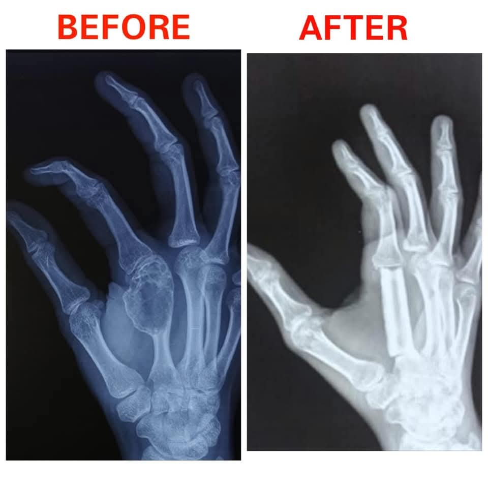 Successful Hand Bone Reconstruction by Dr. Ravi Krishna MS Ortho in Chidambaram