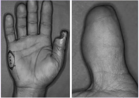 Hypothenar Local Flap Reconstruction by Dr. Ravi Krishna MS Ortho in Chidambaram