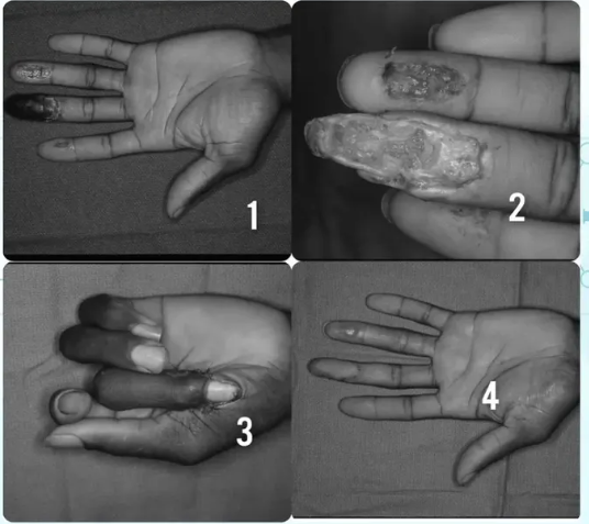 Thenar Local Flap Surgery for Fingertip Injury by Dr. Ravi Krishna MS Ortho in Chidambaram